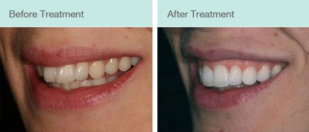 C Fast Tooth Straightening Before and After Treatment