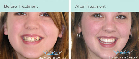 6 Months Smiles Dental Treatment