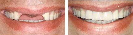 Bridges Before and After Treatment