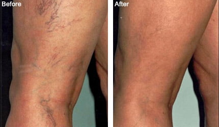 Microsclerotherapy. Thread Vein Removal