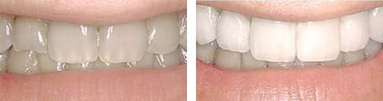 Tooth Whitening Before and After Treatment