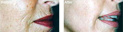 Genuine Dermaroller Therapy Before and After Treatment